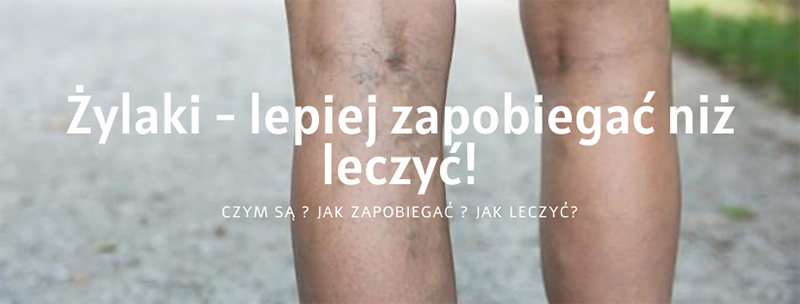 jak zapobiegać pajączką czym są żylaki