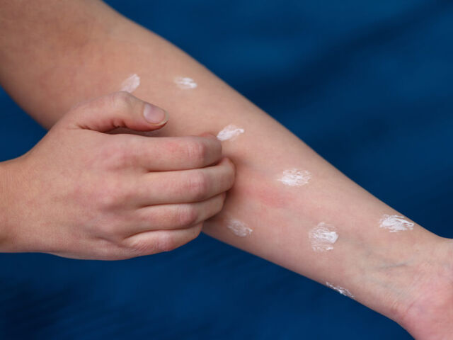 Alergia skórna - przyczyny, objawy i sposoby leczenia. Jak złagodzić uczuelnie skórne?
